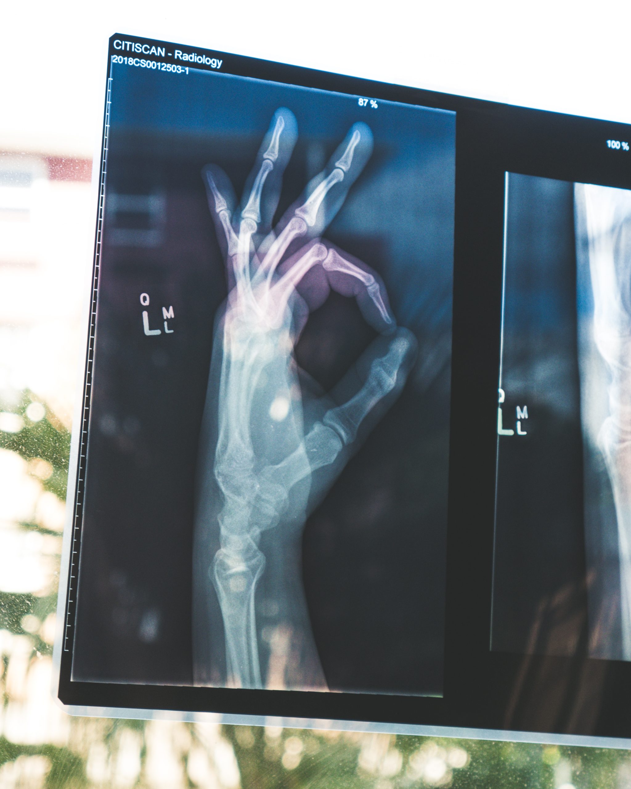 An x - ray of a hand with an x - ray of a hand.